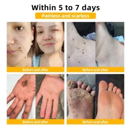 Mole And Wart Body Cream Fade Skin Cleaning