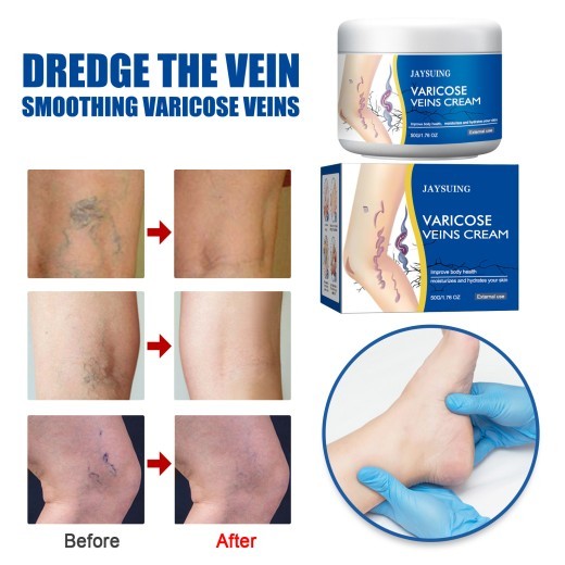 Leg Vein Repair Cream Varicose Massage Earthworm Legs